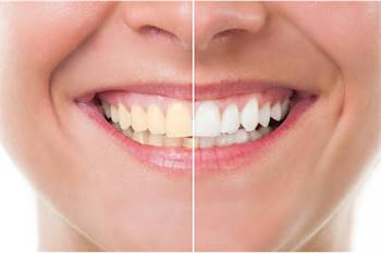 Best teeth whitening treatment in Fort Worth